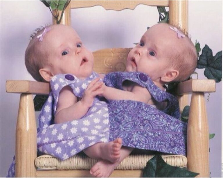 Exploring the Dynamic World of Conjoined Twins Kendra and Maliyah!